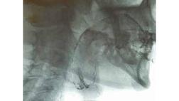 Фиброваскулярный полип пищевода.